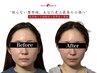 【削らない整形級。あなた史上最高の小顔へ】美容鍼×小顔矯正×高周波×整体