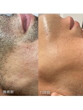 カウピリ(kaupili)/【脱毛】ビフォーアフター