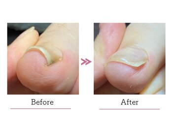 シスターズネイル アンド コンパス(Sisters Nail & Compass)/巻き爪