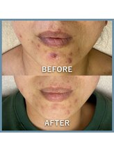 エステ シンセリティー(aesthetic sincerity)/肌質美肌改善/毛穴洗浄/シミケア