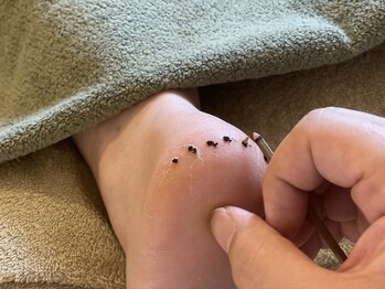 スクナビコナ鍼灸院/お灸でガサガサ踵もツルツルに？