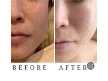 リジュベネ(rejuvena)/【リフトアップコース＋ハーブ】