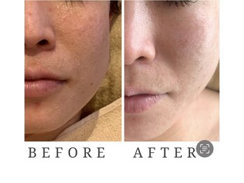 リジュベネ(rejuvena)/【リフトアップコース＋ハーブ】