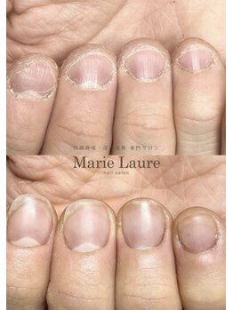 マリーロール 天王寺店(Marie Laure)/自爪育成/深爪矯正/ネイルケア