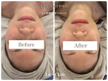 スキンセラピーサロン ル クレール(Le Clair)/Before→After