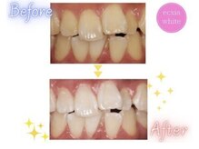 エクシアホワイトニング エミフルMASAKI店/ホワイトニングビフォーアフター