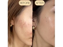 ハーブリプロならお肌の中からお悩みを根本改善してくれます◎