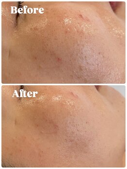 クラティス 塩尻店(CRATIS)/高濃度エクソソーム導入