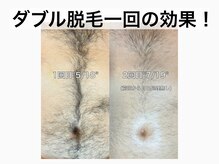 ナンバーエー 新宿店(No. A)/"当店一番人気！ダブル脱毛"