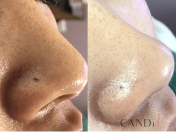 キャンディ 岐阜(CANDi)/ハイドラピーリング/黒ずみ毛穴