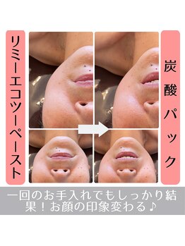 ラ ルミエール(La Lumiere)/ホームケアにも人気の炭酸パック