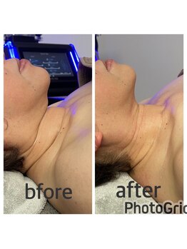 マールム(MALUM)/CMフェイシャル　before/after