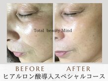 トータルビューティー マインド(Total Beauty)/《ヒアルロン酸導入セラピー》