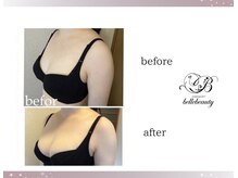 ベルビューティー(belle beauty)/バストアップ◇症例◇