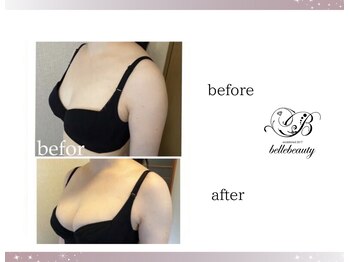 ベルビューティー(belle beauty)/バストアップ◇症例◇