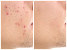 ルクシア(RUXCIA)/ビフォーアフターピーリング20回