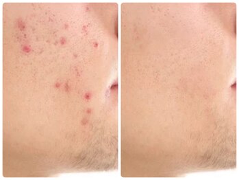 ルクシア(RUXCIA)/ビフォーアフターピーリング20回