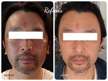 クリニカルエステ リフィーナ 西荻窪店/西荻窪でメンズ美容