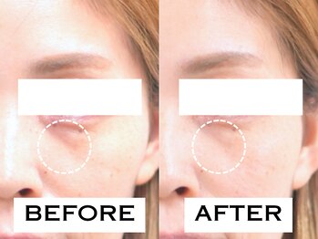 ビハリスト 新宿南口/目元のゴルゴ線が改善！