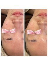 美温(mion)/おまかせフェイシャル