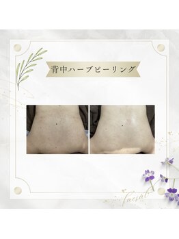 アディッシモ(addissimo)/気になる跡や赤みにも☆