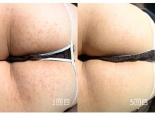 エミルカ 日の出平井店(EMILUCA)/お尻ケアもできます！