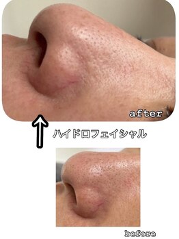 ミラリア(mirallia)の写真/【毛穴レスな陶器肌へ】黒ずみ・ざらつきを徹底ケア☆プロの技術で汚れを落とし、潤い澄み渡る素肌を実現！