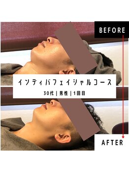 東京デトックス/インディバフェイシャル