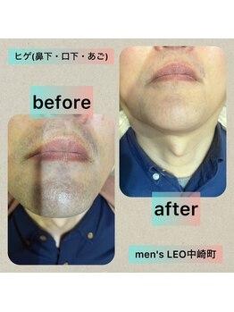 ランドマーク 中崎町(LANDMARK.)/《 鼻下・口下・あご 》