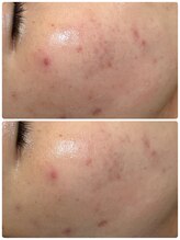 ジェニー(JENNI)/LDM 施術1回