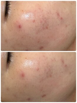 ジェニー(JENNI)/LDM 施術1回