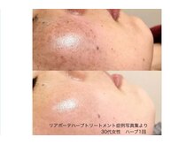 ラペ(la paix)/フェイシャル症例写真