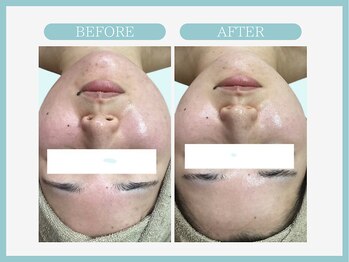 アコガレコガオ 八戸店/