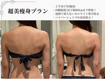 ラブミー 渋谷本店(LoveMe)/骨盤/ハイパーナイフEX/渋谷痩身