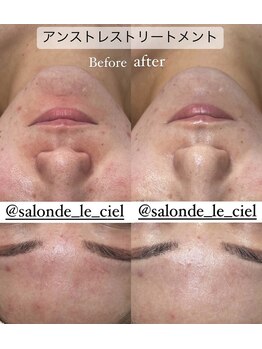 サロンドゥルシェル(salonde_le ciel)/毛穴洗浄＋アンストレス