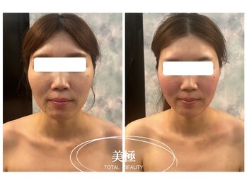 美極 銀座店/銀座/小顔コルギ/小顔矯正