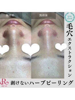 ダブル(W)/毛穴ケア×ハーブピーリング