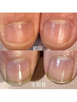 ココデネイル(cocode nail)/悩み:爪噛み(20代後半)その1