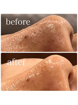 ディス イズ ミー エステティック(This is Me Aesthetic)/男性にも人気毛穴洗浄！