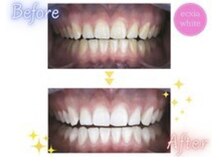 エクシアホワイトニング エミフルMASAKI店/ホワイトニングビフォーアフター