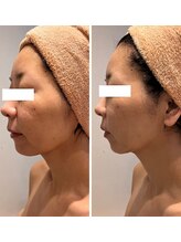 エムフルール(M fleur)/小顔detoxフェイシャル