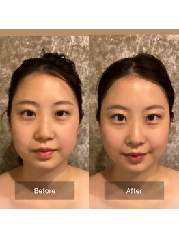 アンド ボナール(&-bonnard)/施術Before/After 