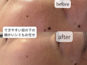 サロン ドロップ 上小田井(Salon drop)/「シミ改善」