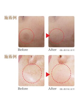 レイ 本厚木(Rei)の写真/最先端技術の次世代シミケアで透明感ある肌へ！ダウンタイム無し痛み無しが嬉しい♪