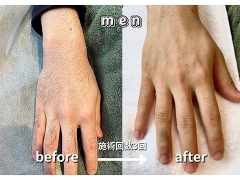 キュー(cue)/【メンズ】「腕脱毛」施術事例