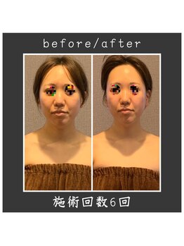 サロン ド ハーモニー美/コルギ♪小顔・面長改善・鼻高等