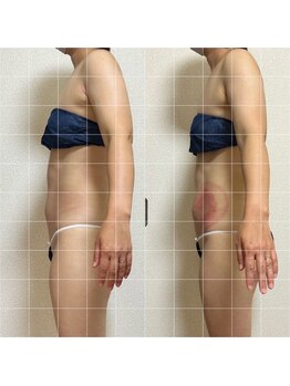 リノリー 古川店(rinory)/「お腹集中！脂肪冷却」