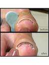 巻爪改善ケアで隠れた角質もケア