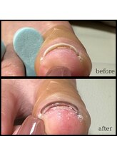 アムネイル(am.nail)/巻爪改善ケアで隠れた角質もケア