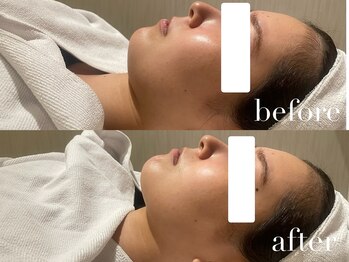 上野エステサロン レア(Lea)/今話題の小顔レモンボトル